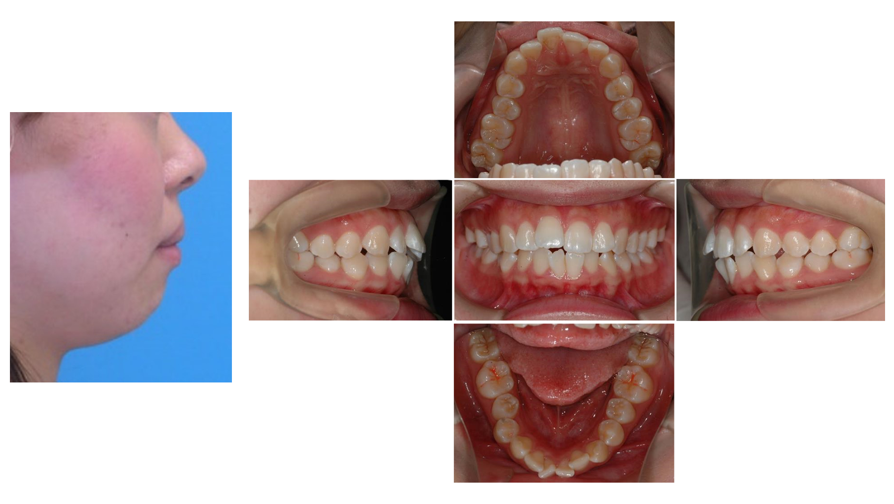 千葉市中央区千葉寺・おおもり歯科クリニック・Case3　上下顎前突症例
